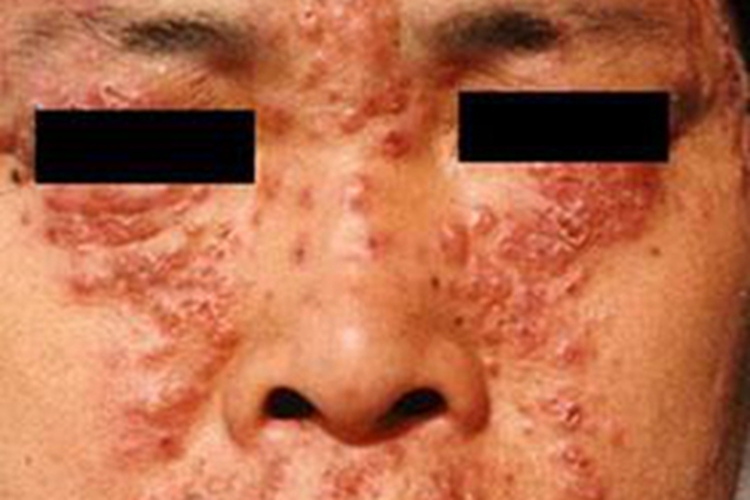 寻常狼疮疙瘩图