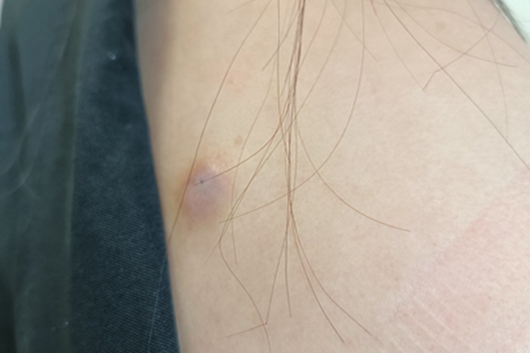 皮脂腺囊肿背部有疙瘩结痂图 皮脂腺囊肿背部有疙瘩结痂图