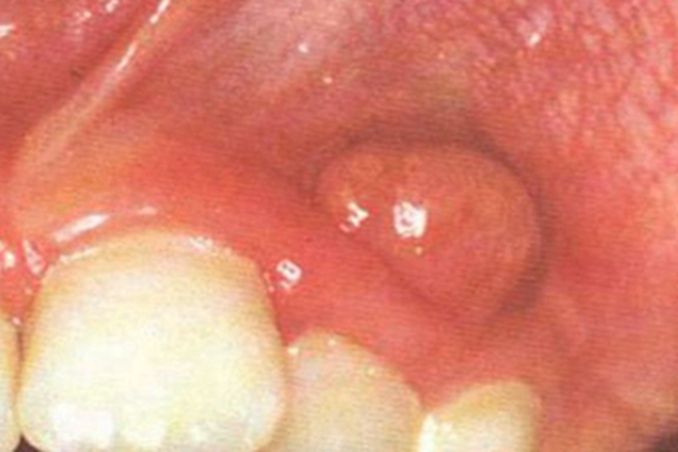 急性浆液性根尖周炎牙龈肿胀图