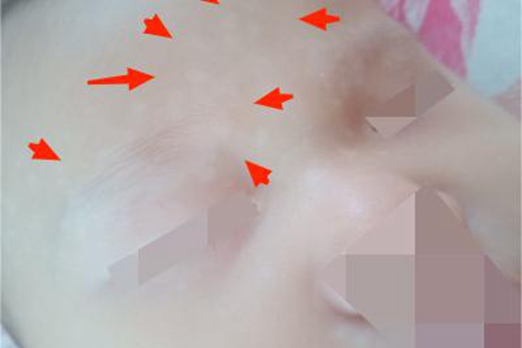 花斑癣额头上有大片白斑图