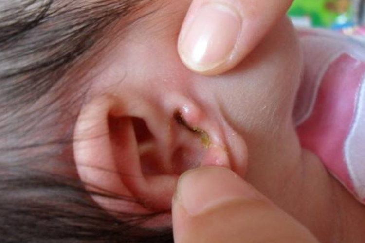 急性化脓性中耳炎化脓图