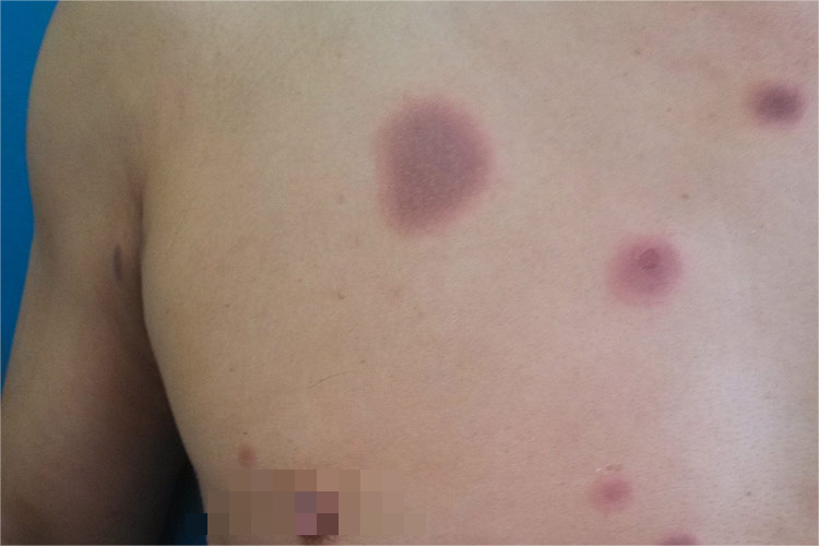 麝香过敏固定型皮损图