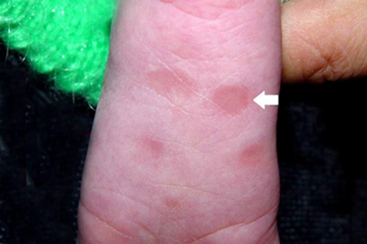 三期梅毒脚底有红斑图