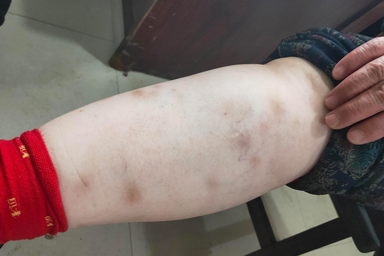 风湿热皮下结节图