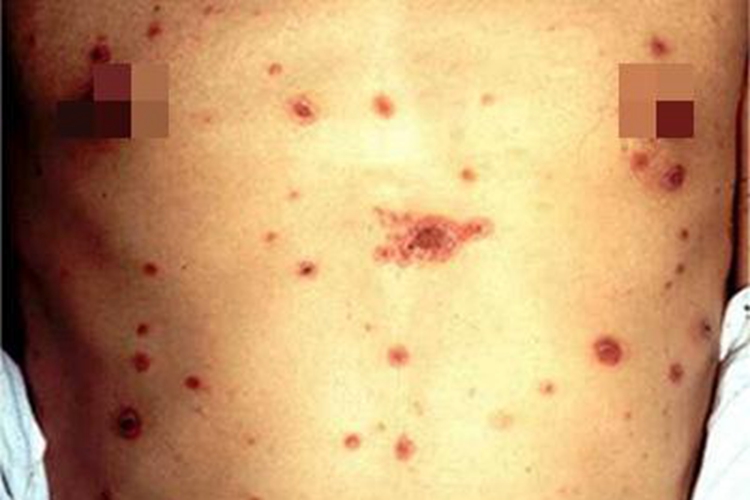 结节性梅毒疹腹部症状图