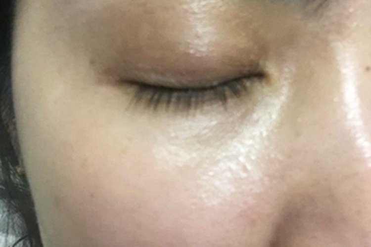 眶周色素沉着症眼睑颜色加深图