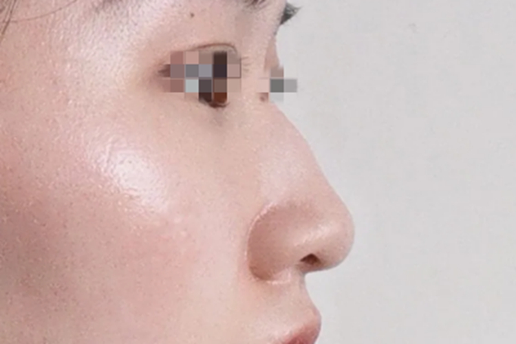 驼峰鼻鼻尖隆起弯曲图