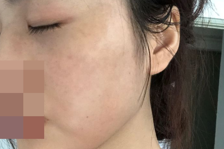 色素沉着消退图