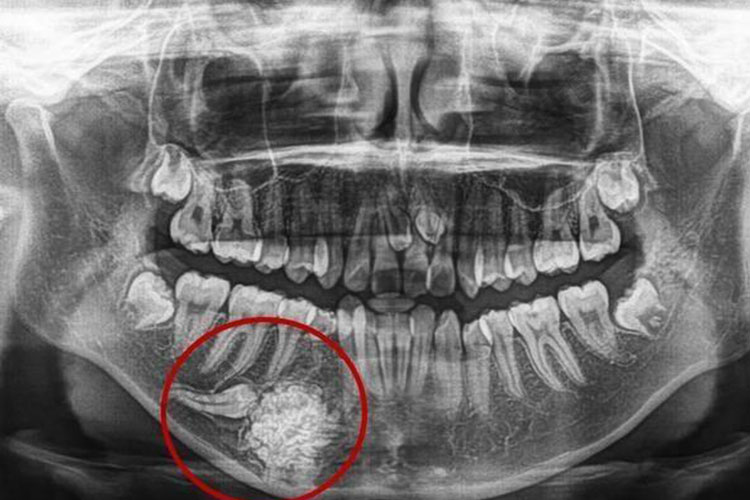 牙源性钙化上皮瘤X线图