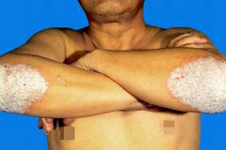 苔藓状淀粉样变肘部脱屑图