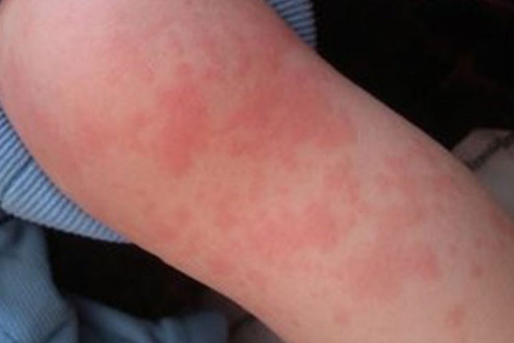 冷接触性荨麻疹风团图