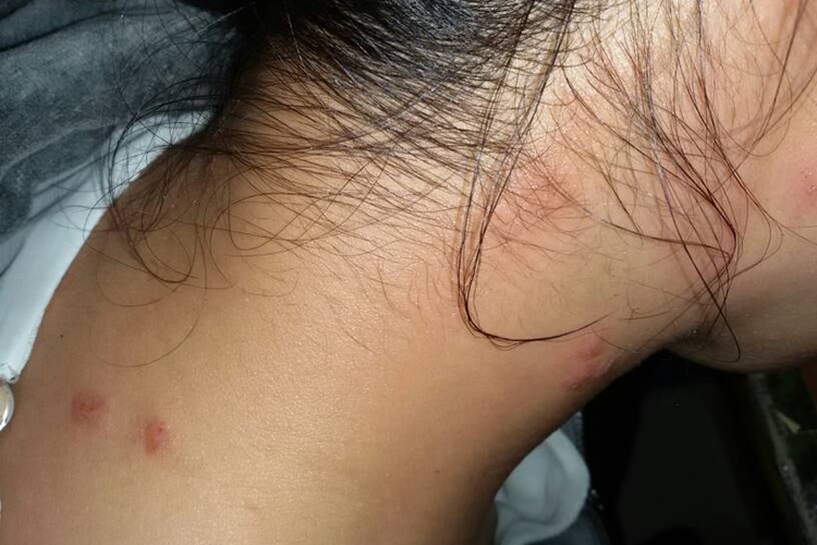 丘疹性荨麻疹颈部症状图 丘疹性荨麻疹颈部症状图