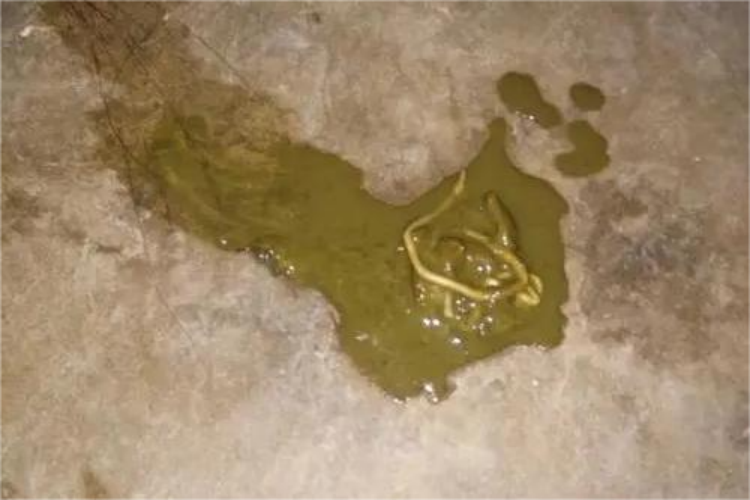 婴儿寄生虫感染粪便图 婴儿寄生虫感染粪便图