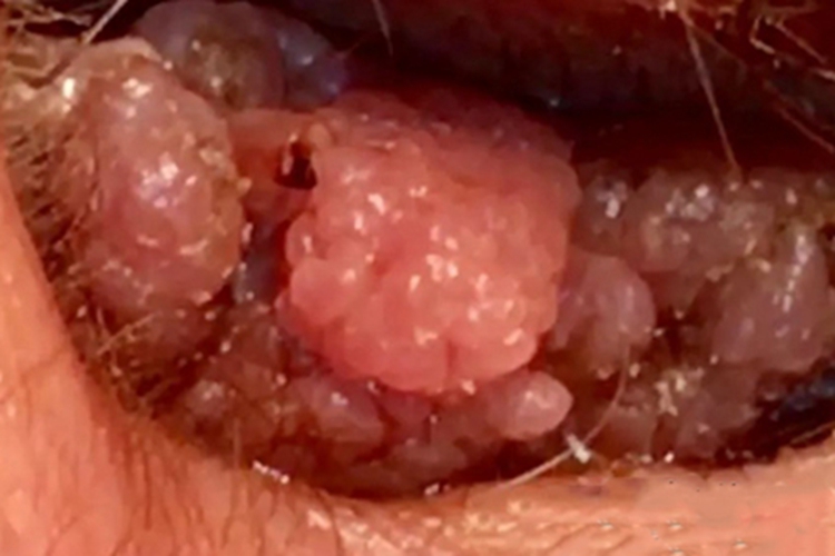 外耳道乳头状瘤瘤图