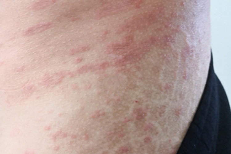 玫瑰糠疹腰部症状图