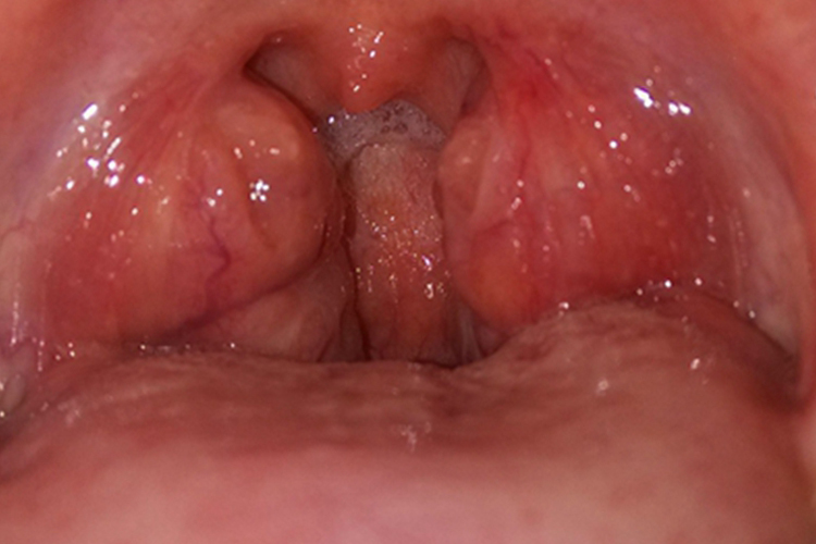 小孩扁桃体肥大图