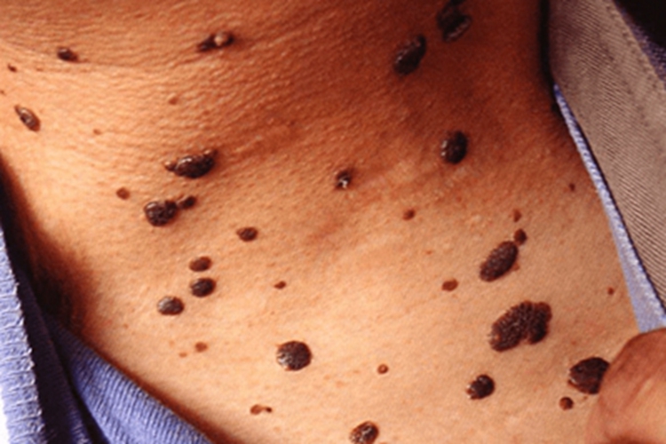 局限性血管角化瘤症状图