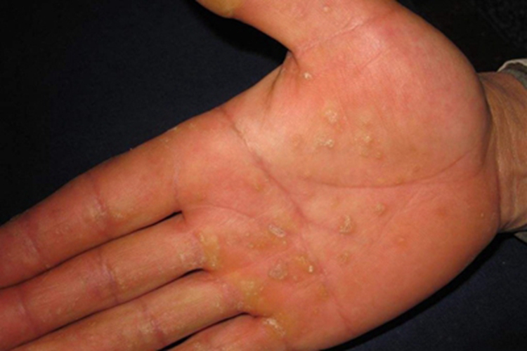 点状掌跖角化病手掌疙瘩图 点状掌跖角化病手掌疙瘩图
