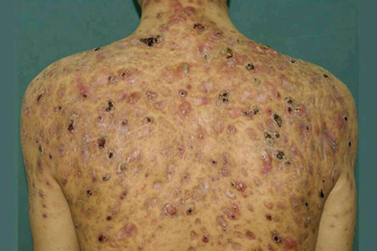 聚合性痤疮背部脓包图