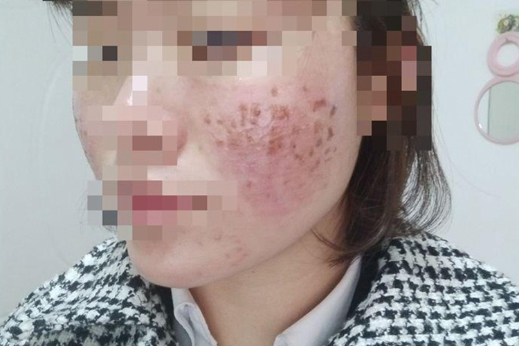 激光祛痘印后第2-3天恢复图 激光祛痘印后第2-3天恢复图