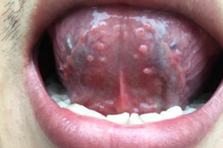 口腔尖锐湿疣舌头肉粒图 口腔尖锐湿疣舌头肉粒图