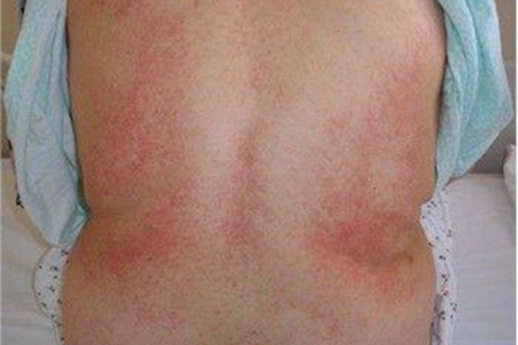 血栓性血小板减少性紫癜红点图 血栓性血小板减少性紫癜红点图