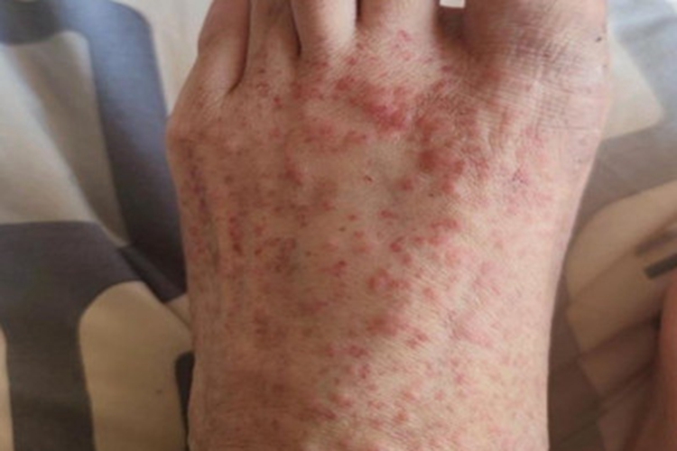 皮肤小血管炎脚背疙瘩图