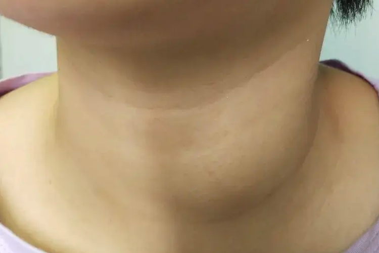 甲状腺结节脖子肿大图