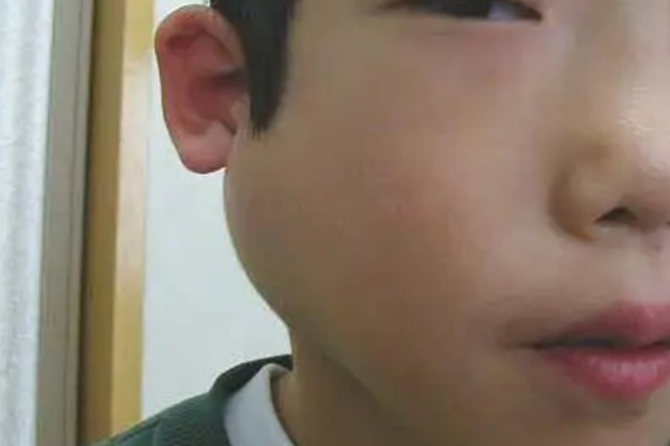 流行性腮腺炎右脸肿图 流行性腮腺炎右脸肿图