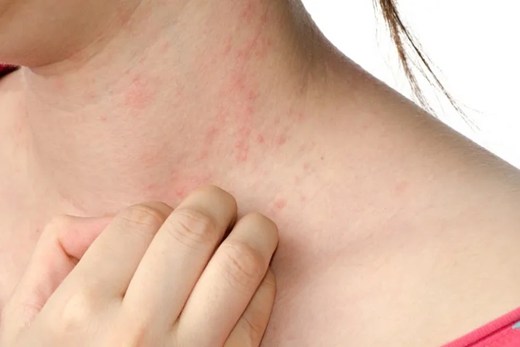 脖子湿疹图