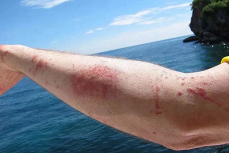 海蜇蜇伤小疙瘩图 海蜇蜇伤小疙瘩图