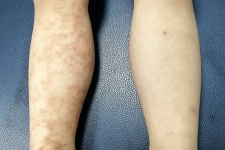 单纯性紫癜小腿红斑图