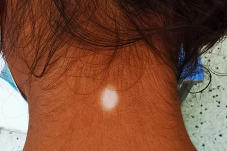 白癜风后颈白斑图 白癜风后颈白斑图