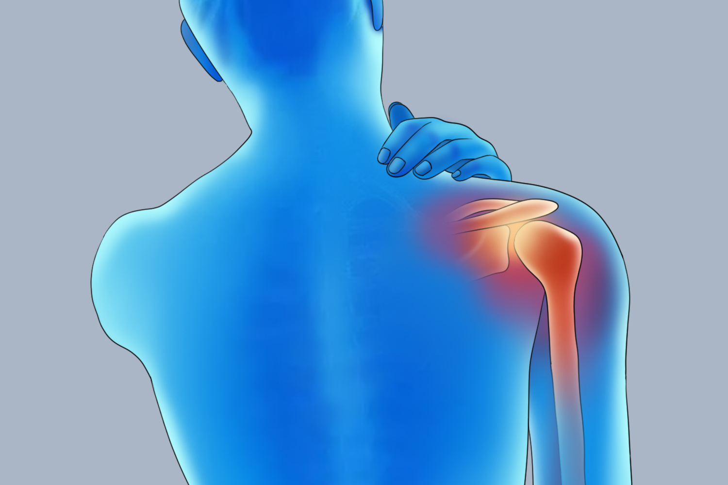 肩袖损伤位置图