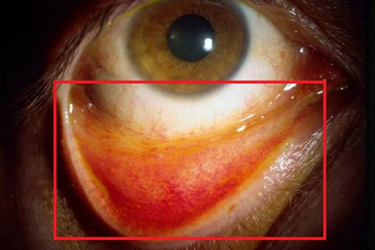 腺病毒性角结膜炎血点图 腺病毒性角结膜炎血点图