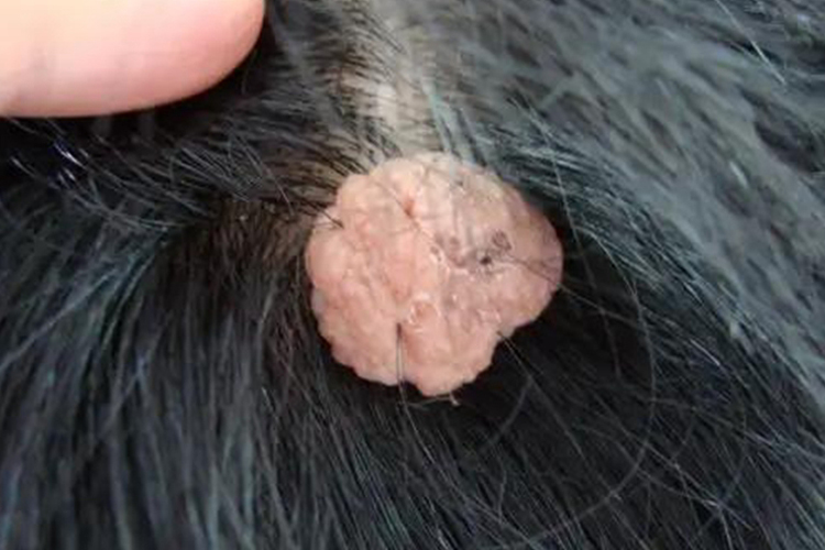 头皮软纤维瘤图