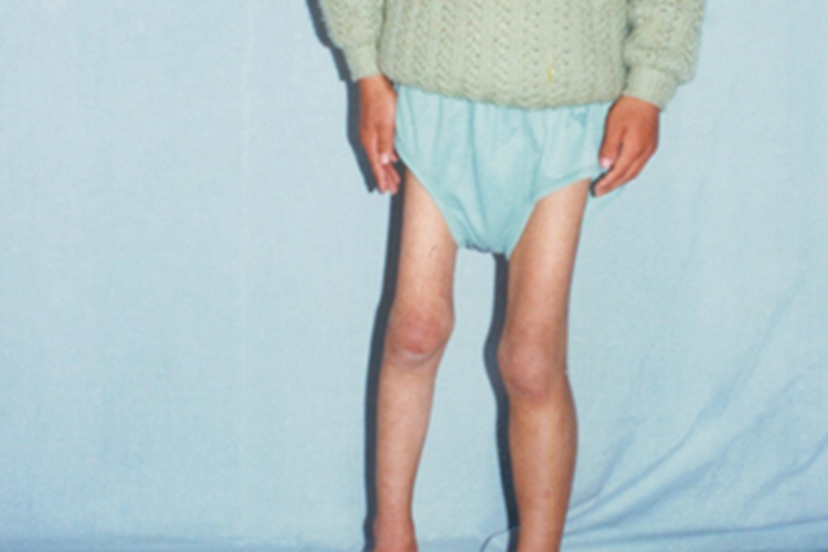 地方性克汀病腿症状图 地方性克汀病腿症状图