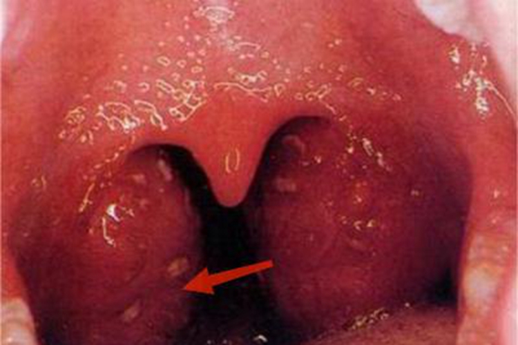 化脓性扁桃体炎化脓图