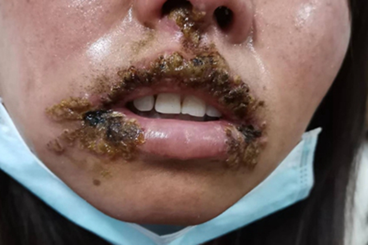 带状疱疹嘴唇水肿结痂图 带状疱疹嘴唇水肿结痂图