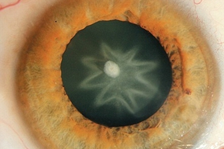 眼部钝挫伤所致白内障症状图 眼部钝挫伤所致白内障症状图