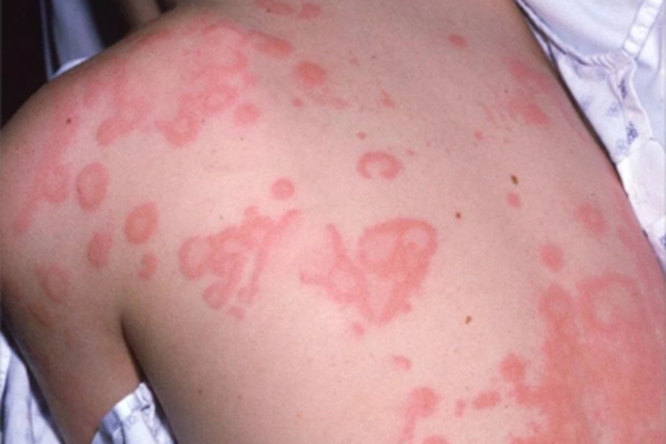 慢性自发性荨麻疹背部风团图 慢性自发性荨麻疹背部风团图