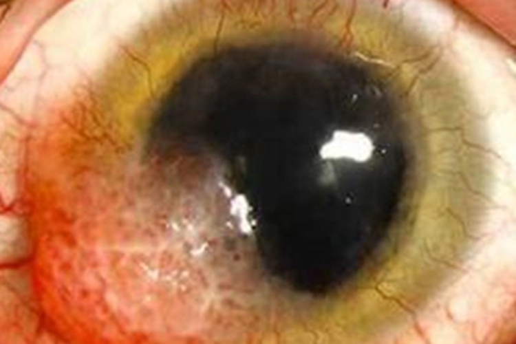 结膜乳头状瘤结膜瘤图