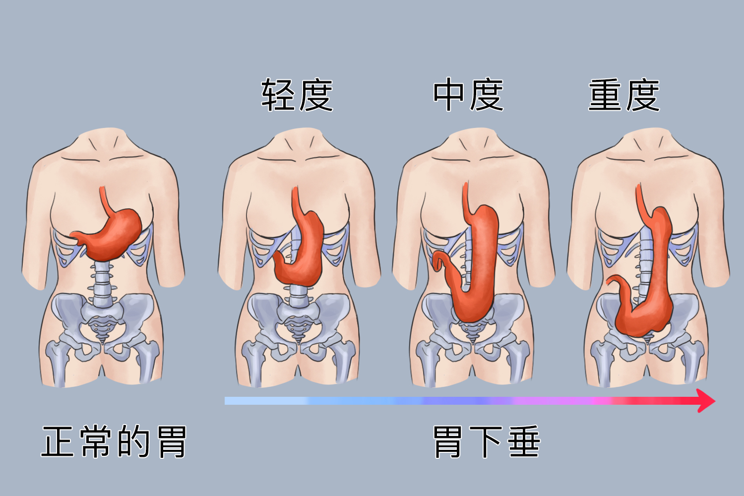 女性胃下垂的肚子图
