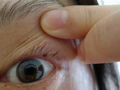 眼睑交界痣上眼皮内侧有一个小黑点图
