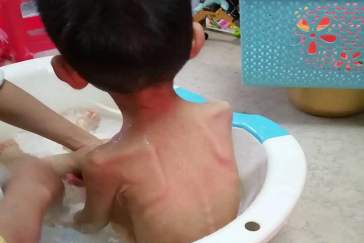 孩子奶痨形体消瘦图