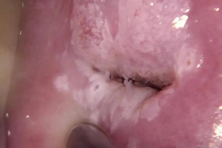 阴道壁有白色豆腐渣分泌物图