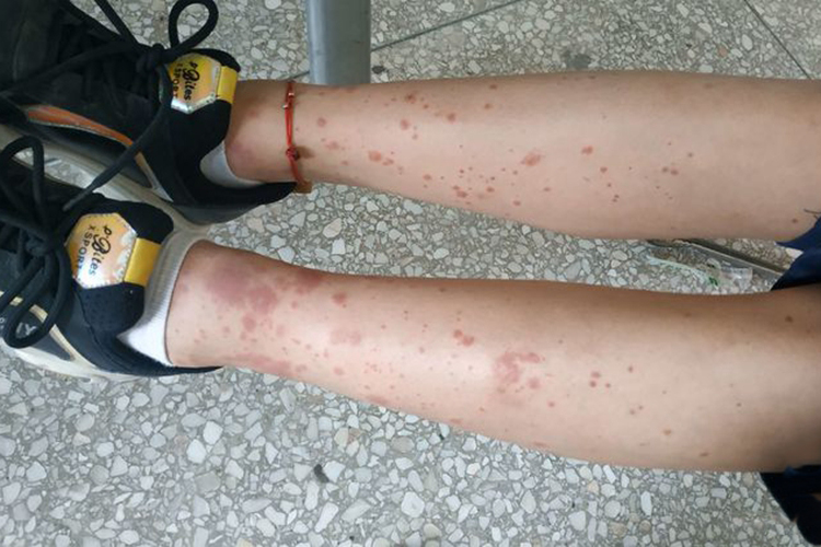 紫癜红色丘疹图 紫癜红色丘疹图