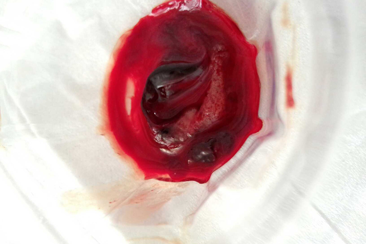 生化妊娠属于早期流产,妊娠物排出前胚胎多已死亡,一般在开始时绒毛与