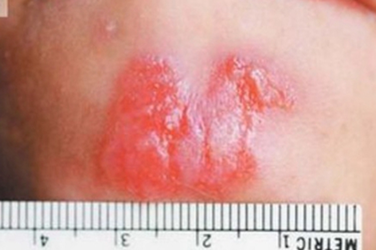 皮肤利什曼病下巴发红图 皮肤利什曼病下巴发红图