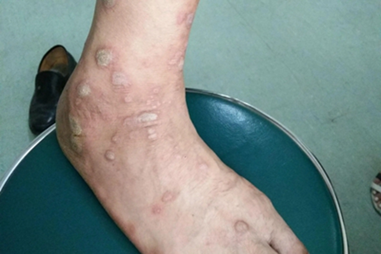 光化性痒疹脚背结节图